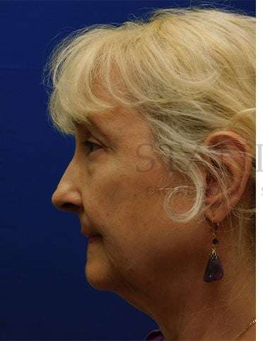 Lower Blepharoplasty Before & After Patient #859