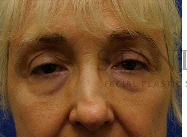 Lower Blepharoplasty Before & After Patient #859