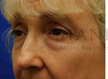 Lower Blepharoplasty Before & After Patient #859