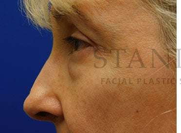 Lower Blepharoplasty Before & After Patient #859