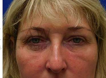 Lower Blepharoplasty Before & After Patient #844