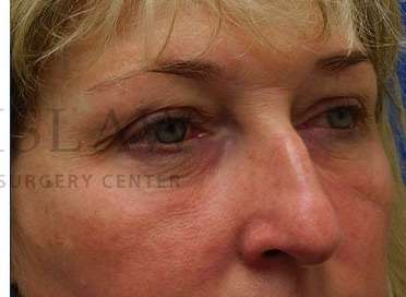 Lower Blepharoplasty Before & After Patient #844