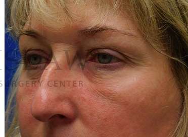 Lower Blepharoplasty Before & After Patient #844