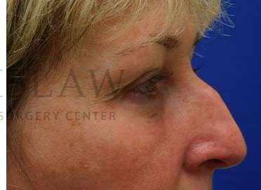 Lower Blepharoplasty Before & After Patient #844