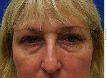 Lower Blepharoplasty Before & After Patient #844