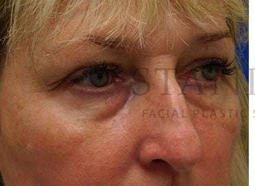 Lower Blepharoplasty Before & After Patient #844