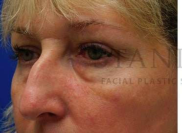 Lower Blepharoplasty Before & After Patient #844