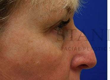 Lower Blepharoplasty Before & After Patient #844