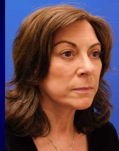 Makeover Before & After Patient #917