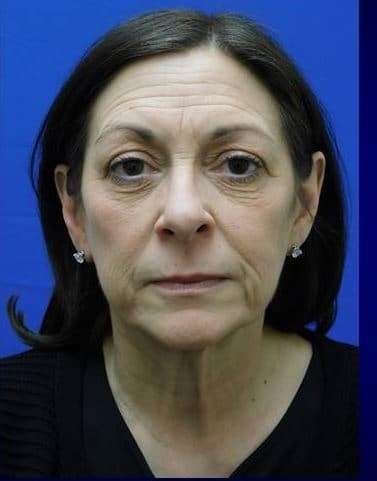 Makeover Before & After Patient #917
