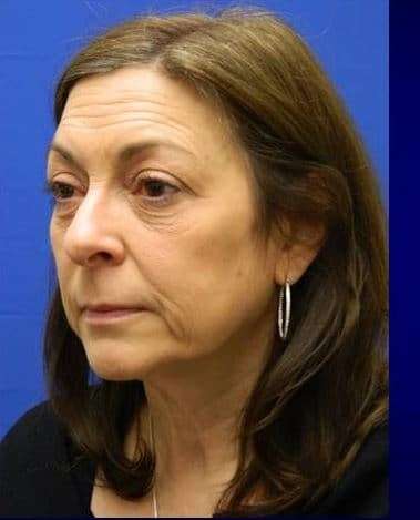 Makeover Before & After Patient #917