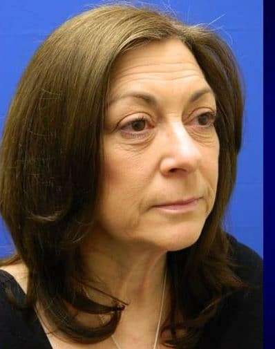 Makeover Before & After Patient #917