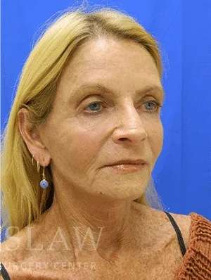 Makeover Before & After Patient #910