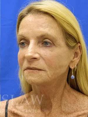 Makeover Before & After Patient #910