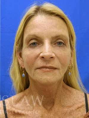 Makeover Before & After Patient #910