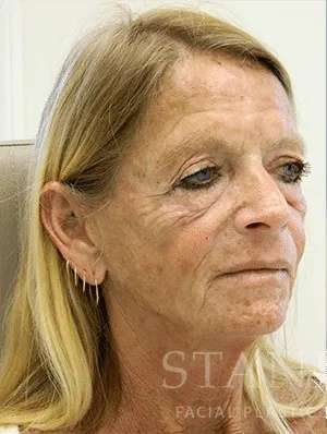 Makeover Before & After Patient #910
