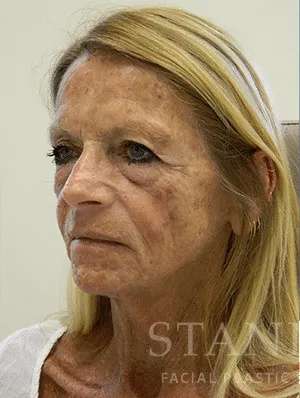 Makeover Before & After Patient #910
