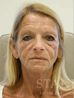 Makeover Before & After Patient #910