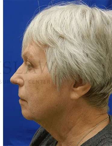 Malar Bags Before & After Patient #939