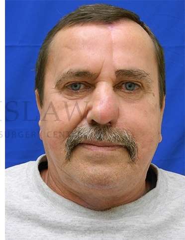 Nose Skin Cancer Before & After Patient #968