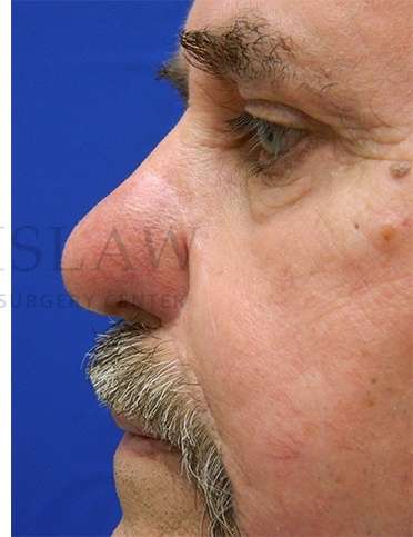 Nose Skin Cancer Before & After Patient #968