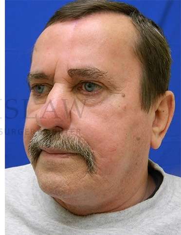 Nose Skin Cancer Before & After Patient #968