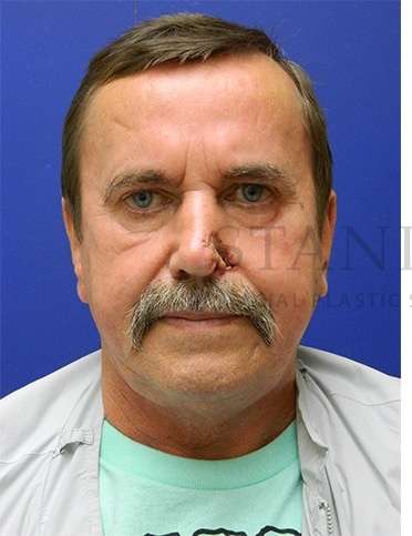 Nose Skin Cancer Before & After Patient #968