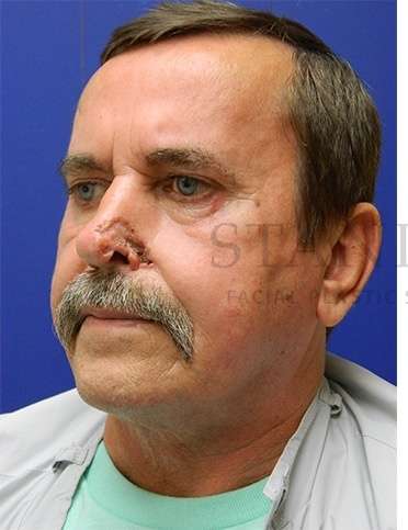 Nose Skin Cancer Before & After Patient #968