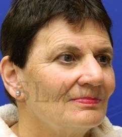Nose Skin Cancer Before & After Patient #961