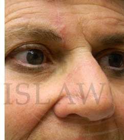 Nose Skin Cancer Before & After Patient #961
