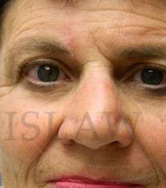 Nose Skin Cancer Before & After Patient #961