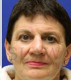 Nose Skin Cancer Before & After Patient #961