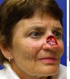 Nose Skin Cancer Before & After Patient #961