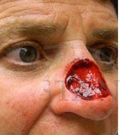 Nose Skin Cancer Before & After Patient #961