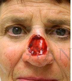 Nose Skin Cancer Before & After Patient #961