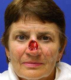 Nose Skin Cancer Before & After Patient #961