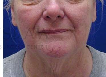Nose Skin Cancer Before & After Patient #952