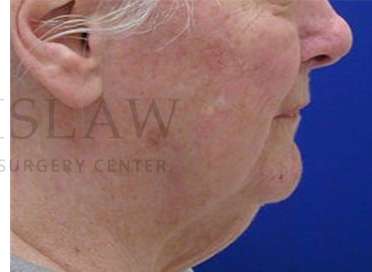 Nose Skin Cancer Before & After Patient #952