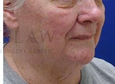 Nose Skin Cancer Before & After Patient #952
