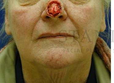 Nose Skin Cancer Before & After Patient #952