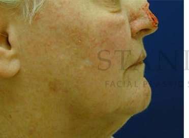 Nose Skin Cancer Before & After Patient #952