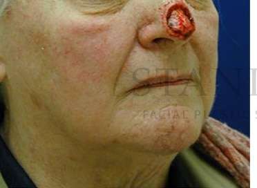 Nose Skin Cancer Before & After Patient #952