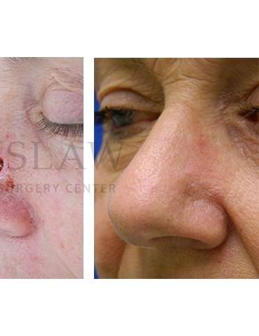 Nose Skin Cancer Before & After Patient #945