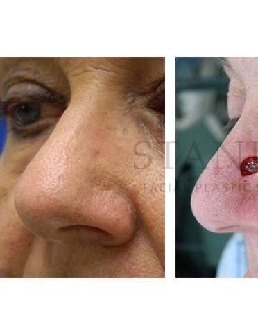 Nose Skin Cancer Before & After Patient #945