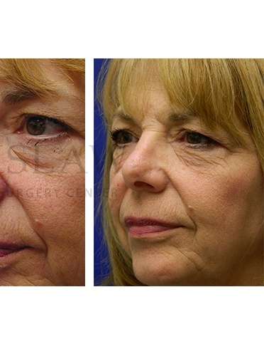 Nose Skin Cancer Before & After Patient #942
