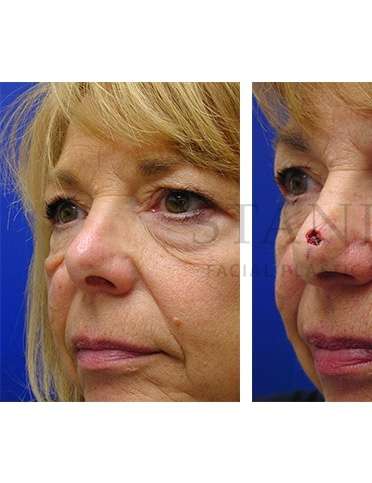 Nose Skin Cancer Before & After Patient #942