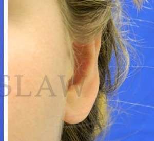 Otoplasty Before & After Patient #1051