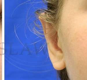 Otoplasty Before & After Patient #1051