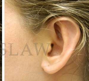Otoplasty Before & After Patient #1051