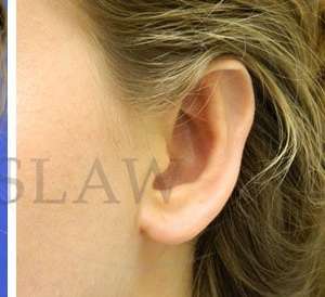 Otoplasty Before & After Patient #1051